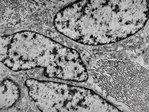 M,50y. | fibrous tumor - pleura